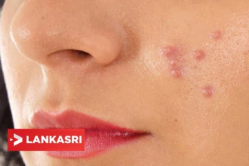 ஒரே இரவில் பருக்களை விரட்டணுமா? இதோ சூப்பர் டிப்ஸ்