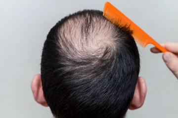 உச்சந்தலையில் முடி அதிகம் கொட்டுதா? இந்த ஆபத்தாக கூட இருக்கலாம்!