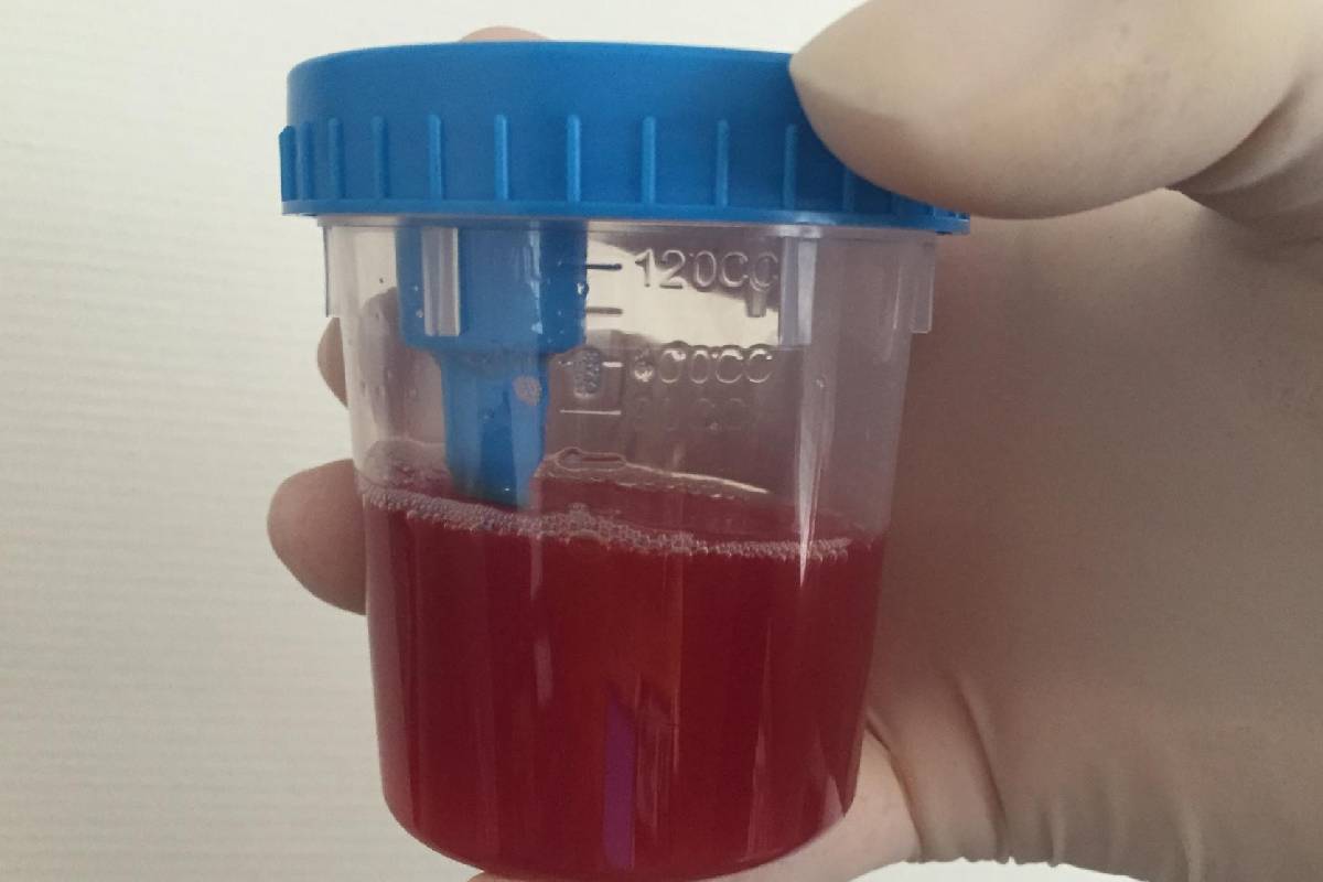 சிறுநீருடன் இரத்தம் வருகிறதா? அப்போ இந்த நோய் இருக்கு... ஜாக்கிரதை | Blood In Urine Sign Of Serious Disease