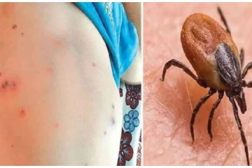 கனடாவில் பரவி வரும் நோய் குறித்து எச்சரிக்கை