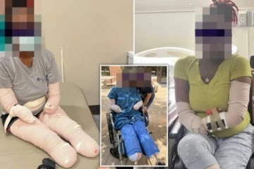 கொரோனாவால் கை, கால்களை இழந்த பெண்! கண்ணீர் விட்டு அழுத மருத்துவர்: வெளியிட்ட வீடியோ