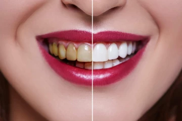 மஞ்சள் பற்கள் உங்களை அசிங்க படுத்துகின்றதா? வெண்மையாக பளிச்சிட இவை மட்டும் போதும்!