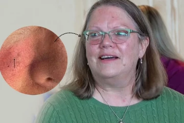 ලොව කුඩාම සමෙහි පිළිකාව හඳුනා ගනි..! (PHOTOS)