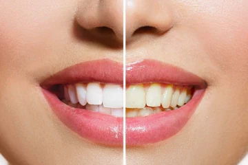 மஞ்சள் பற்கள் வெண்மையாய் மாற வேண்டுமா...அப்போ இதை பண்ணுங்க