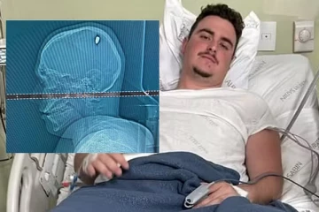 தலையில் இறங்கிய 9 MM புல்லட் ; 4 நாள்களாக தெரியாமல் இருந்த இளைஞர்