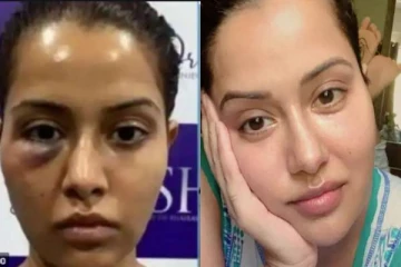 பழைய நிலைக்கு முகம் சரியானது எப்படி? விளக்களித்த நடிகை ரைசா வில்சன்!