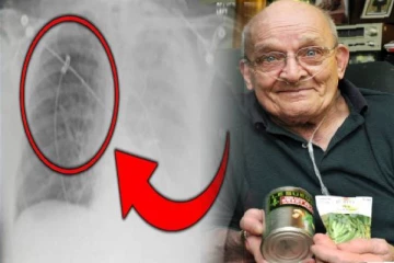 நுரையீரலில் வளர்ந்த பட்டாணிச் செடி ; அமெரிக்க மருத்துவர்களை ஆச்சரியப்படுத்திய அறுவை சிகிச்சை