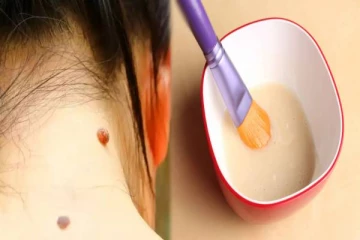 மருக்கள் நிரந்தரமாக நீங்க வேண்டுமா? அப்போ இதை செய்யுங்கள்