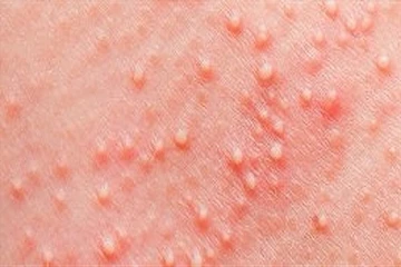 சூட்டு கொப்புளங்களால் அவதியா? இதனை போக்க இதோ சில வீட்டு வைத்தியங்கள்!