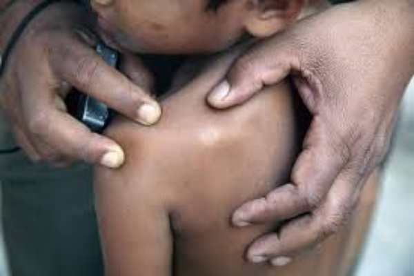 இலங்கையில் மாவட்டமொன்றில் அதிகரிக்கும் தொழுநோய் | Leprosy In Moratuwa Increasing