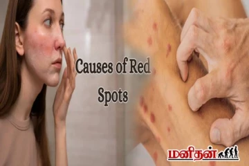 Red Spots on Skin: சருமத்தில் தோன்றும் சிவப்பு புள்ளிகள் ஆபத்தானதா? மருத்துவ விளக்கம்