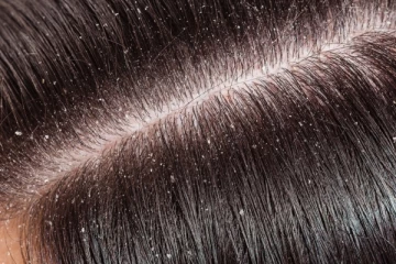 பொடுகு பிரச்சினையா? இதனை தடுக்க என்ன செய்யலாம்?