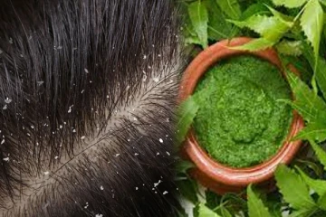 தாங்க முடியாத பொடுகுத் தொல்லையா? இத மட்டும் ட்ரை பண்ணுங்க போதும்