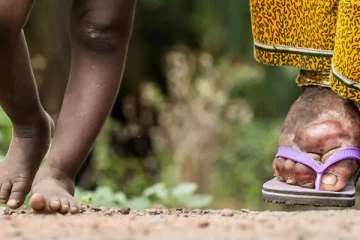 මෙරට තවත් රෝගී තත්වයක් ඉහළට.