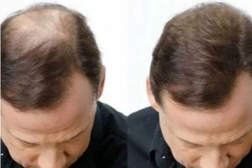 சொட்டை விழுந்த பகுதியில் உடனே முடி வளர! எளிதான டிப்ஸ்