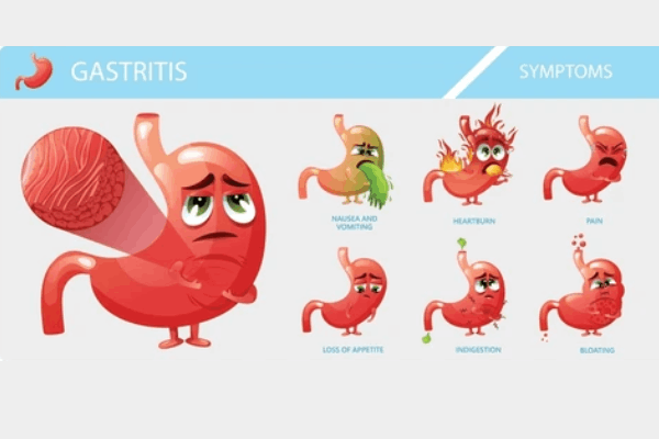 මේවා කළොත් ගැස්ට්‍රයිටීස් රෝගයට නිට්ටාවටම තිත  | Gastritis Causes Symptoms And Natural Cure