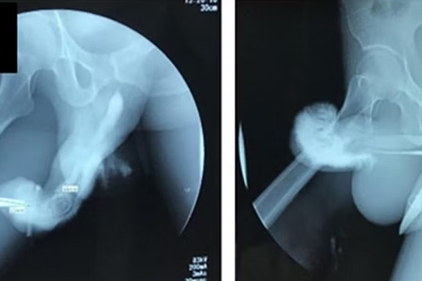 அந்த சமயத்தில் ஆணுறுப்பில் எலும்பு முறிவு - இறுதியில் நடந்தது என்ன ? | Man Breaks Penis While Performing Most Dangerous அந்த சமயத்தில் ஆணுறுப்பில் எலும்பு முறிவு - இறுதியில் நடந்தது என்ன ? | Man Breaks Penis While Performing Most Dangerous