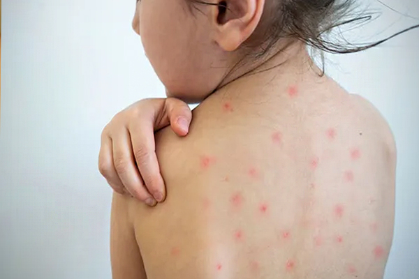 பிரித்தானியாவை அச்சுறுத்தும் நோய்த்தாக்கம்: விடுக்கப்பட்டுள்ள சுகாதார எச்சரிக்கை | A Health Warning Has Been Issued Across The Uk