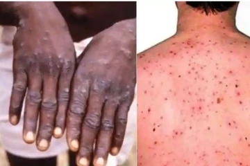 வேகமெடுக்கும் குரங்கு அம்மை நோய்! உலக சுகாதார அமைப்பு தகவல்