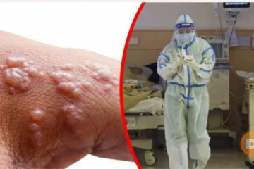 මෙරටින් දෙවන මංකිපොක්ස් ආසාදිතයත් හඳුනා ගැනේ..!