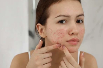 முகப்பருவினால் அவதிப்படுகிறீர்களா? அருமையான தீர்வு இதோ