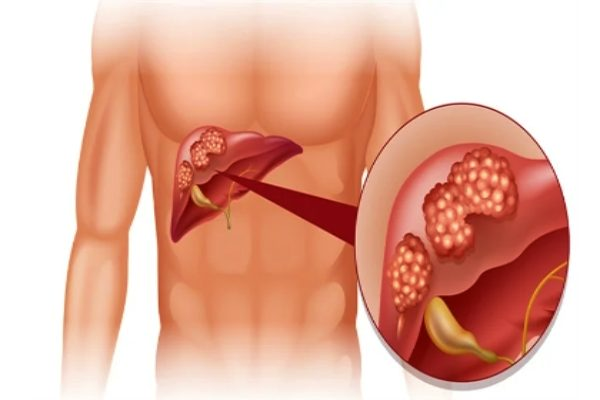 இந்த 4 அறிகுறிகள் இருக்கா? உங்க கல்லீரலை பத்திரமா பாத்துகோங்க | A Sign Of Liver Damage Should Never Ignore Tamil இந்த 4 அறிகுறிகள் இருக்கா? உங்க கல்லீரலை பத்திரமா பாத்துகோங்க | A Sign Of Liver Damage Should Never Ignore Tamil
