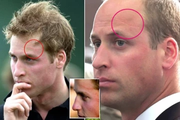 இளவரசர் வில்லியமின் "ஹாரி பாட்டர்” வடு! குழந்தைப் பருவ விபத்து ரகசியம்