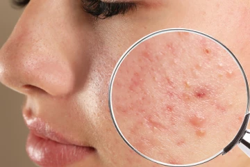 முகத்தை அசிங்கமாக்கும் சரும வடுக்களை போக்க வேண்டுமா? இதோ அசத்தலான டிப்ஸ்