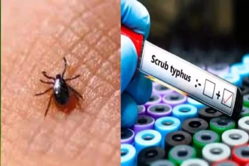 தமிழகத்தில் அதிகரிக்கும் ஸ்க்ரப் டைபஸ் காய்ச்சல் - அறிகுறிகள் என்னென்ன?