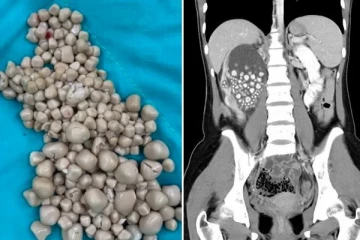 இளம்பெண் சிறுநீரகத்தில் இருந்த 300 கற்கள்: மருத்துவர்கள் கூறிய அதிர்ச்சி காரணம்