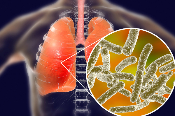 உலகை மிரட்டும் புதிய நோய் - ஆர்ஜென்டினாவில் 4 பேர் பலி | Legionnaires Disease Symptoms History Argentine