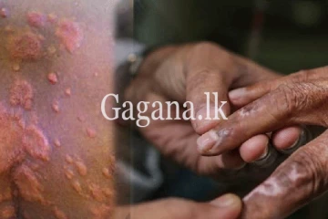 මෙරට ලාදුරු මඬින්න WHO එනවලු.