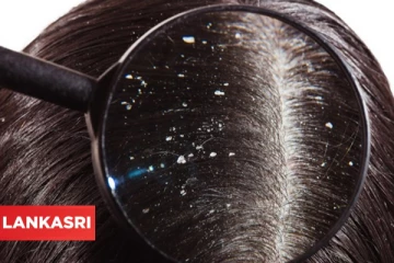 கூந்தலை பாதிக்கும் பொடுகு பிரச்சினைக்கு தீர்வு வேண்டுமா?