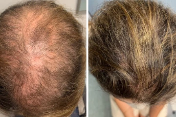 5 மடங்கு முடி அடர்த்தியாக வளரனுமா? வீட்டிலேயே எண்ணெய் தயாரிப்பது எப்படி?