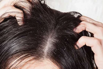 பொடுகை நிரந்தரமாக அடியோடு விரட்ட வேண்டுமா? சில எளிய வழிகள் இதோ