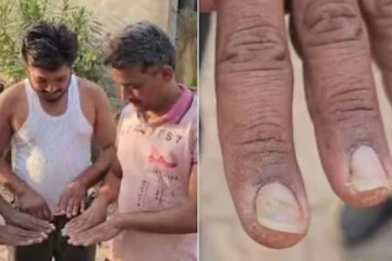 வழுக்கையை தொடர்ந்து நக சிதைவு - கதறும் 18 கிராமங்கள்