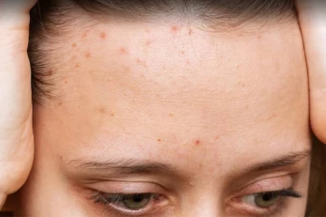 நெற்றியில் முகப்பரு தோன்றியதா? - அதற்கான காரணங்கள் இதோ...