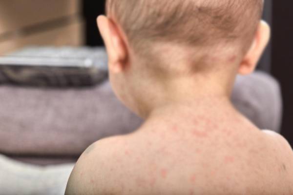 அமெரிக்காவின் தென் கரோலினா மாகாணத்தில் வேகமாக பரவும் தட்டம்மை நோய் | Measles Outbreak In South Carolina Usa