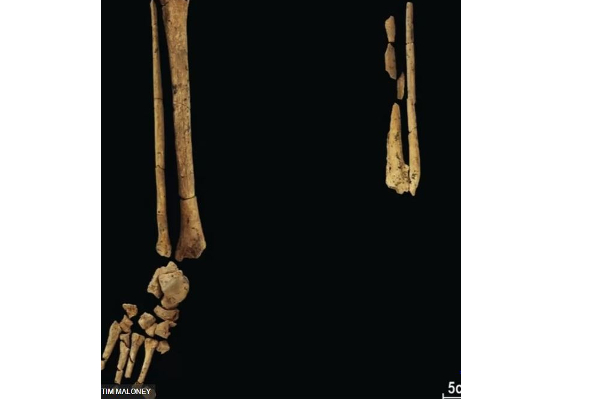 ஆதிமனிதன் வரலாறு: 31,000 ஆண்டுக்கு முன்பே உறுப்பு நீக்க அறுவைச் சிகிச்சை செய்த குகை மனிதன் | Caveman Who Underwent Amputation Surgery