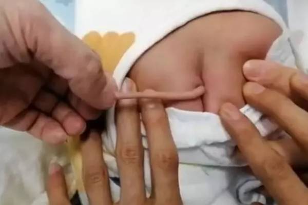 baby born 10 cm tail in china