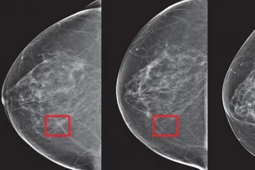 5 ஆண்டுக்கு முன்பே மார்பக புற்றுநோயை கண்டறிய முடியும் ; AIயின் புதிய தொழில்நுட்பம்