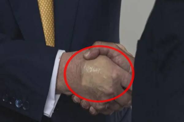 டிரம்பின் வலது கையில் பேண்டேஜ் ; கரோலின் லீவிட் விளக்கம் | Trump Has Bandage His Right Hand Caroline Explains டிரம்பின் வலது கையில் பேண்டேஜ் ; கரோலின் லீவிட் விளக்கம் | Trump Has Bandage His Right Hand Caroline Explains