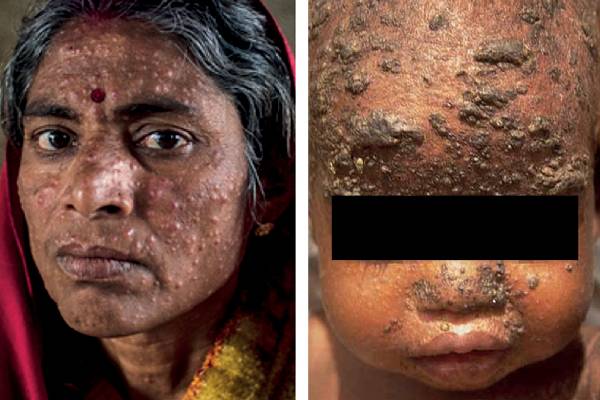 leishmaniasis-symptoms: லீஷ்மேனியாசிஸ் என்றால் என்ன? இந்த அறிகுறிகள் இருந்தா ஜாக்கிரதை! | Kalaazar Visceral Leishmaniasis Symptoms In Tamil