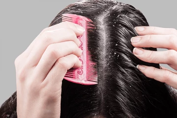 பொடுகு பிரச்சினையை எளிய முறையில் தீர்க்க வேண்டுமா? இதோ அசத்தலான டிப்ஸ்