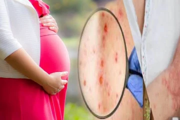 குரங்கு அம்மை: கர்ப்பிணி பெண்களுக்கு கருக்கலைப்பு ஏற்படலாமென எச்சரிக்கை