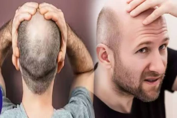 ஆண்களுக்கு வழுக்கை ஏற்பட என்ன காரணம் தெரியுமா? இனிமேல் உஷாரா இருங்க!