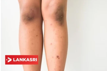 உங்க கால்களில் உள்ள கரும்புள்ளிகள் மற்றும் தழும்புகளை அகற்றனுமா? இதில் ஏதாவது ஒன்றை பின்பற்றுங்க!