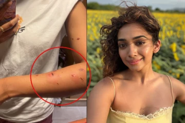 ஷூட்டிங்கில் சூடான எண்ணெயால் நடந்த விபத்து.. நடிகை சான்வே மேக்னாவுக்கு மோசமான காயம்