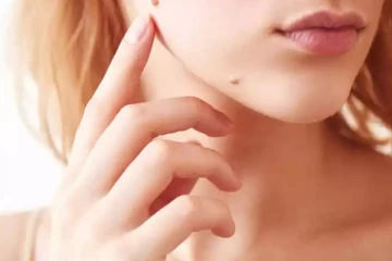 முகம், கழுத்து போன்ற பகுதியில் காணப்படும் மருக்களை போக்க வேண்டுமா? இதோ சில சூப்பரான டிப்ஸ்