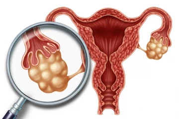 கருப்பையில் உள்ள நீர்க்கட்டிகளை இயற்கை வழியில் கரைக்க வேண்டுமா ?